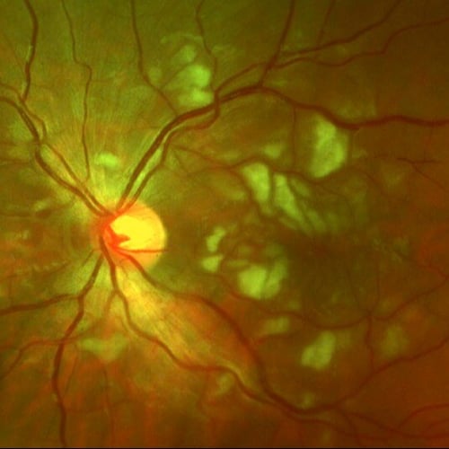 fundus-photo-cotton-wool-spots-macula