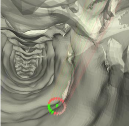 3D Printed Patient-Specific Pedicle Screw Guide & Semi-Automated Planning Software for Accurate Spinal Placement and Optimal Screw Fixation